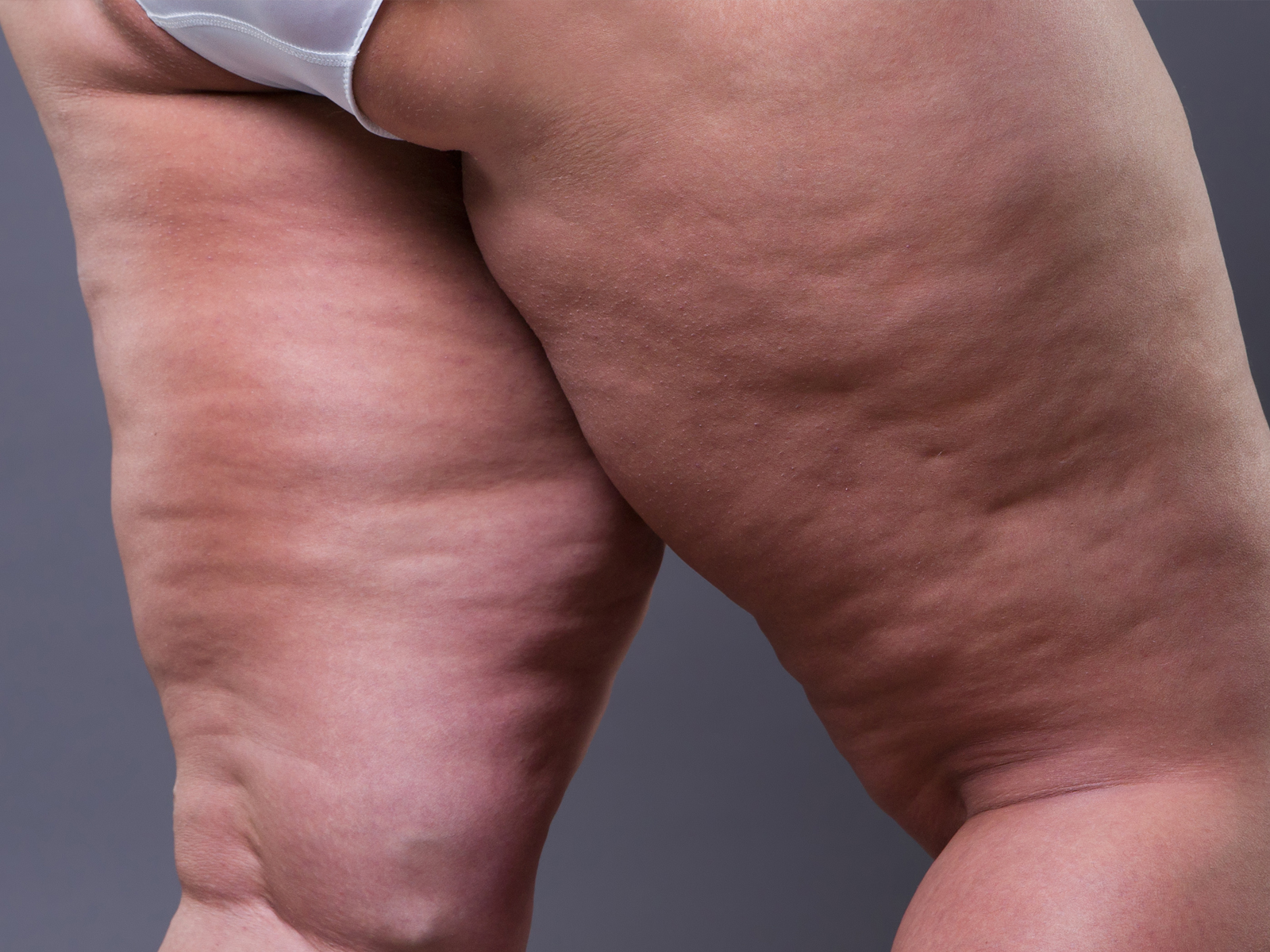 Die Wahrheit über Cellulite: Werfen wir einen Blick auf Ödematöse Fibrosklerotische Pannikulopathie