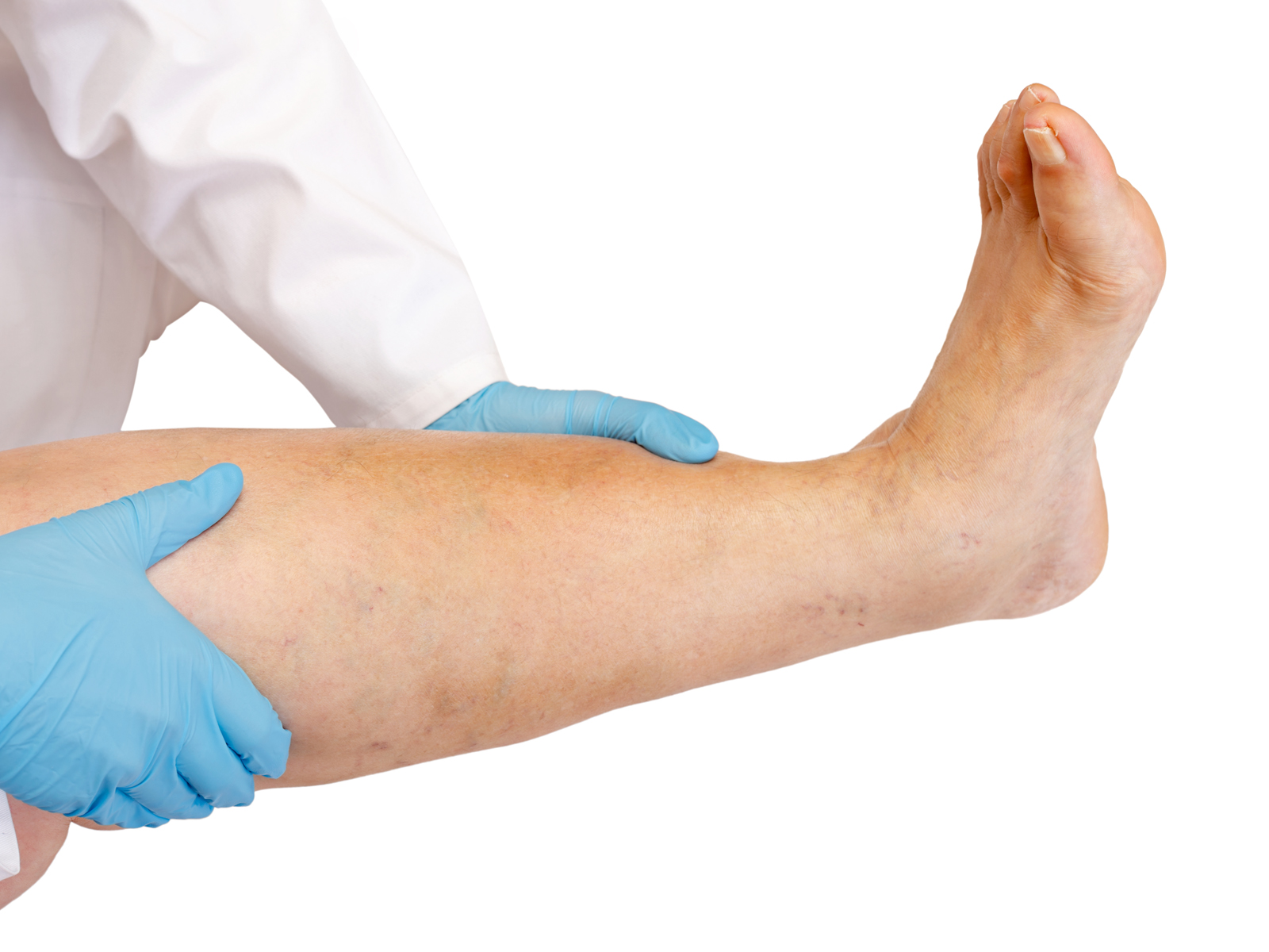 What is venous insufficiency in the legs? Causes, symptoms and solutions